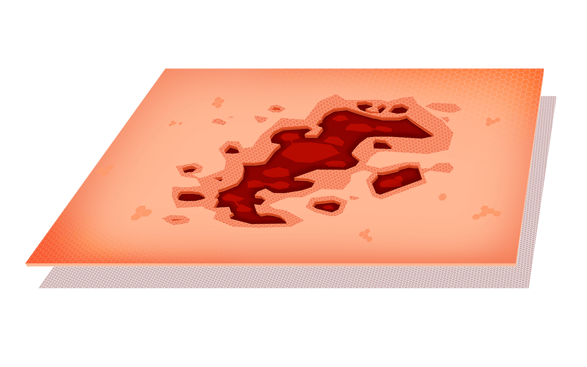 Verbrennungen - Wundheilung, image size:1200x751